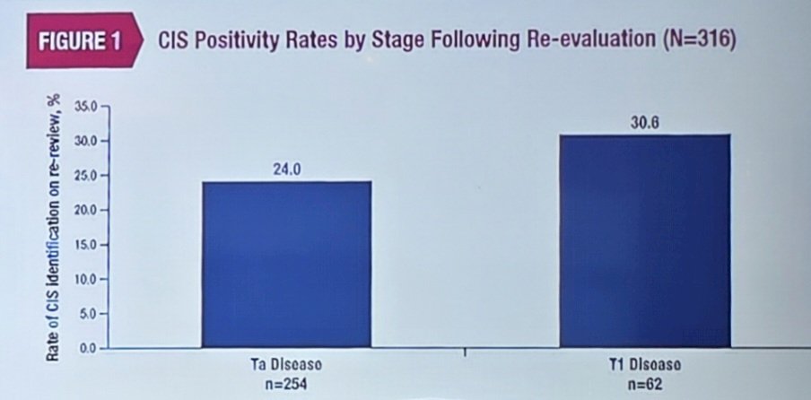 The rate of CIS found on pathology re-review ranged from 15.9% to 66.7% among the 8 pathologists who conducted initial reviews. The difference in the rate of CIS positivity between pathologists was statistically significant (p < 0.05). Overall, there were 80 cases (25.3%) of CIS identified on re-review, which were numerically higher in T1 disease (19/62, 30.6%) than in Ta disease (61/254, 24.0%):