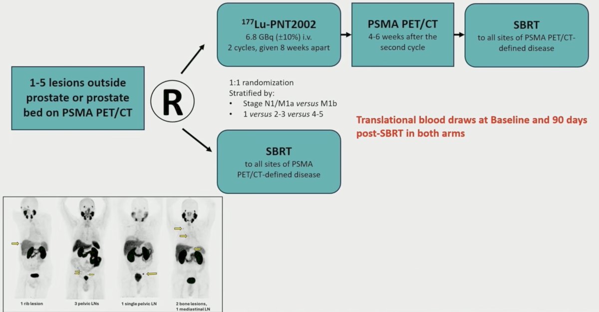 Patients with recurrent oligometastatic hormone sensitive prostate cancer, characterized by 1-5 lesions outside the prostate or prostate bed on PSMA PET/CT, were randomized in a 1:1 fashion to receive either stereotactic body radiotherapy to all metastatic lesions versus 2 cycles of neoadjuvant&nbsp;177Lu-PSMA PNT2002 (6.8 GBq/cycles) 6-8 weeks apart followed by stereotactic body radiotherapy to all metastatic lesions. Stratification was based on the number of lesions (1 versus 2-3 versus 4-5) and PSMA-based stage (N1/M1a versus M1b versus M1c):