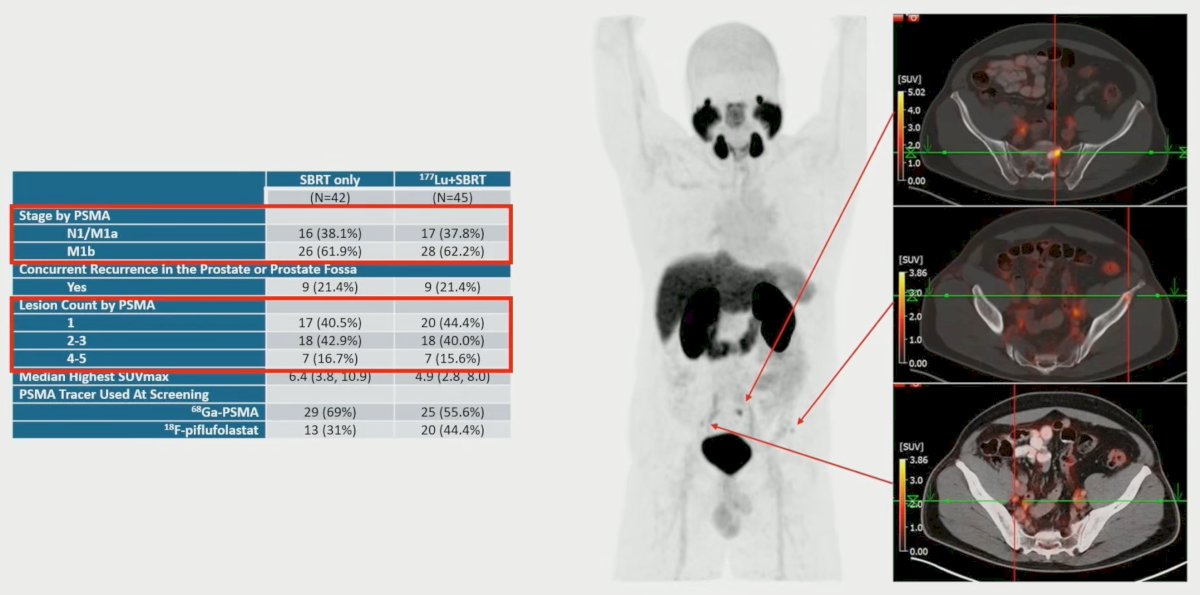 From September 2, 2022, to November 9, 2023, 92 patients were randomized (n = 47 stereotactic body radiotherapy alone, n = 45&nbsp;177Lu-PSMA + stereotactic body radiotherapy); 5 patients randomized to stereotactic body radiotherapy alone dropped out prior to therapy. The median age was 69 years, and the median PSA was 1.1 ng/dL, with 38% of patients having M1b disease, and 43% of patients having solitary lesions: 2