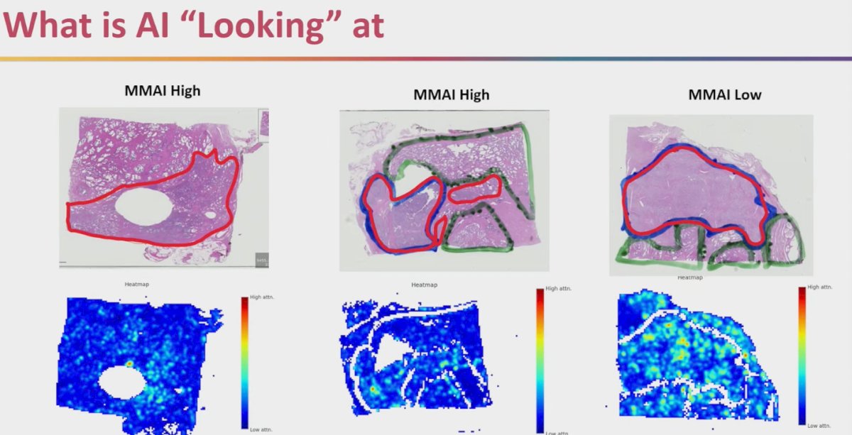 Dr. Sutera emphasized that the AI-driven MMAI model is not pinpointing isolated foci of aggressive disease but is instead focusing on the tumor as a whole. As illustrated in the heat maps, areas of highest attention are concentrated within the malignant tissue, while benign glands and stromal components are largely ignored. This suggests that the AI is capturing biologically relevant features of the tumor itself, rather than being misled by surrounding non-malignant structures.