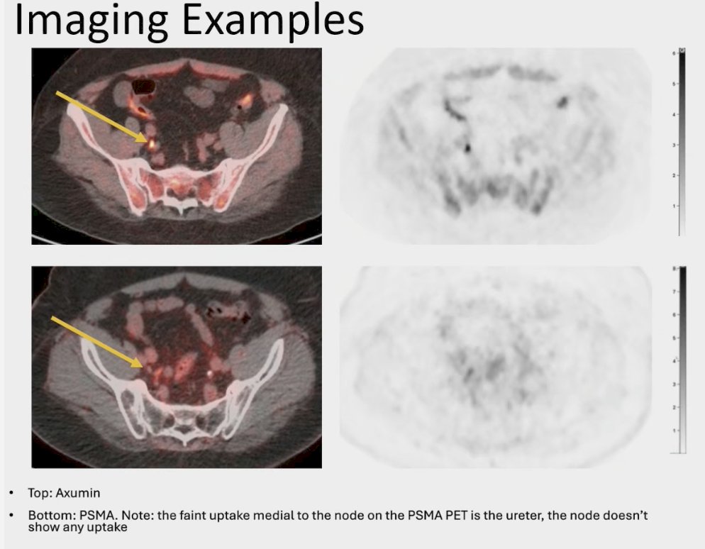 Dr. Eakin presented illustrative cases of patients with PET-avid lymph nodes detected on 18F-fluciclovine (Axumin) PET/CT but not identified on PSMA PET/CT. An example is shown below, with Axumin imaging on the top panel and PSMA PET/CT on the bottom, highlighting situations where fluciclovine may reveal disease sites missed by PSMA imaging.