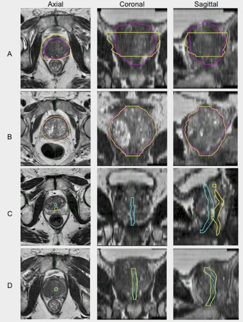Physicians who diagnose or treat prostate cancer were invited to contour the prostate and urethra on up to 4 patient cases using standard T2-weighted MRI (all planes). These contours were compared to reference consensus segmentations produced by a multidisciplinary panel of experts. Performance of a validated prostate auto-segmentation AI tool was also evaluated. The investigators assessed contour accuracy with Dice similarity coefficient, deviation from boundary (mm), absolute volume difference (%), and overlap (%):