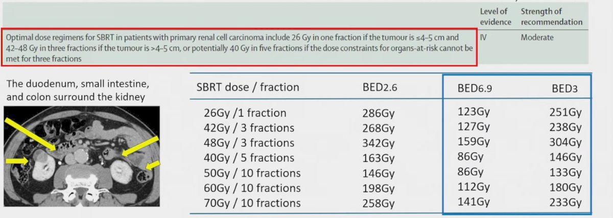 Dr. Onishi highlighted the ISRS practice guidelines, which recommend SBRT regimens of 26 Gy in one fraction for tumors ≤4–5 cm, 42–48 Gy in three fractions for tumors >4–5 cm, or 40 Gy in five fractions when organ-at-risk constraints preclude three-fraction treatment. In contrast, his study employed 50–70 Gy delivered in 10 fractions, which he noted may be particularly useful for tumors located adjacent to the intestine, where stricter dose constraints apply. He further emphasized that if the α/β ratio of RCC is closer to 7 Gy, such a fractionation schedule provides an effective balance between tumor control and treatment safety.