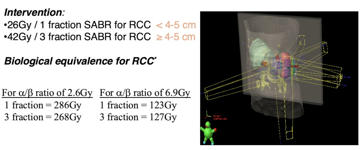 The intervention included 26 Gy in a single fraction for tumors <4–5 cm and 42 Gy in 3 fractions for tumors ≥4–5 cm. She highlighted that, based on RCC-specific α/β ratios (either 2.6 Gy or 6.9 Gy), both regimens achieve comparable biological effective doses ranging from 123–286 Gy suggesting strong radiobiologic rationale for high-dose hypofractionation in this setting. The ITV was defined as the GTV on 4DCT plus an internal margin, with a uniform 5 mm isotropic expansion applied to generate the PTV. In FASTRACK I, treatment was predominantly delivered using 3DCRT, IMRT was also utilized in select cases.