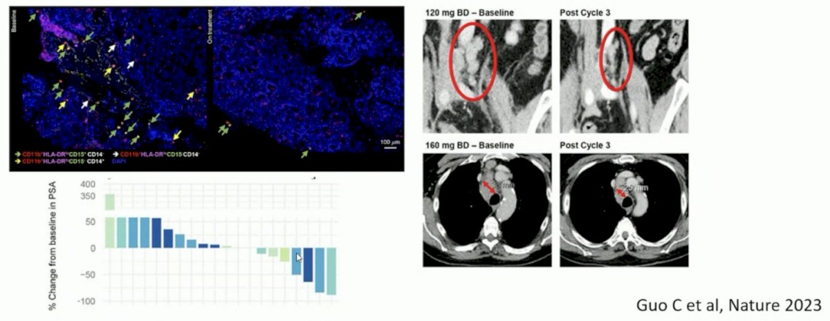 Dr. De Bono also noted that abrogating myeloid infiltration abrogates androgen receptor pathway inhibitor resistance. In work from Guo et al. [2], they showed decreased intratumor myeloid cells and resensitization to enzalutamide, as well as increasing chemokines activates CXCR1 after CXCR2 blockade:&nbsp;