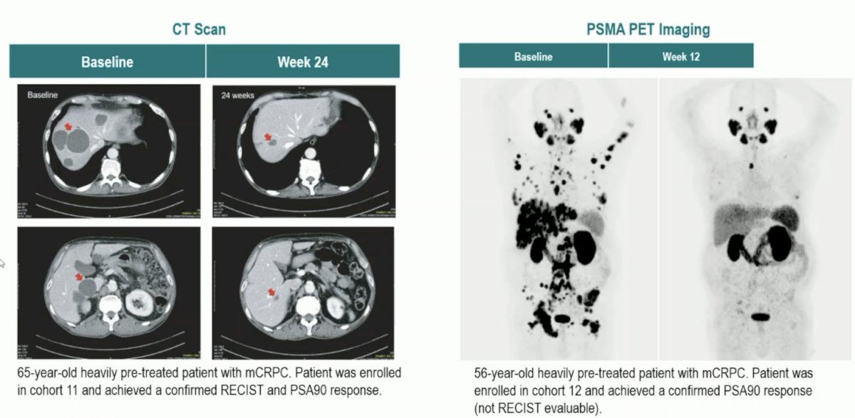 Ultimately, 49% of patients had a PSA50 and 28% had a PSA90 response. Overall, partial response was noted in 24% of patients, but up to 41% of patients in the high dose cohorts. These results correlated with improvement in CT scans and PSMA PET imaging:
