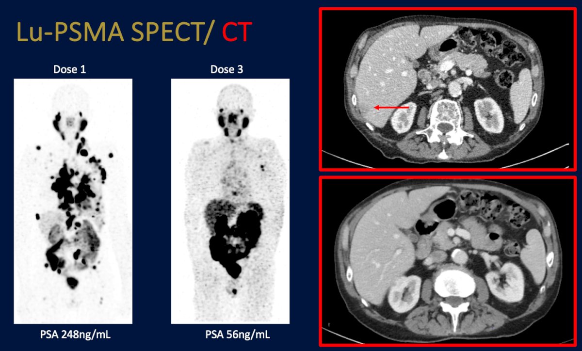 Dr. Emmett emphasized that “everyone deserves at least two doses,” underscoring the importance of reassessing response mid-therapy rather than discontinuing treatment prematurely. Post-treatment Lu-PSMA SPECT/CT allows clinicians to visualize response and tailor therapy accordingly, whether identifying marked responders who may safely stop treatment or detecting progression requiring a change in management. Supporting this, Dr. Thomas Hope shared data showing that nearly half of management changes during RLT were informed by imaging findings, highlighting the critical role of SPECT/CT in real-time decision-making.