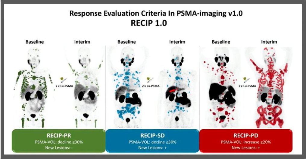 The RECIP (Response Evaluation Criteria in PSMA Imaging) framework is a structured approach for assessing treatment response to 177Lu-PSMA therapy. In a bi-center study of 124 men, baseline and week 12 PSMA PET/CT were analyzed using both quantitative and visual parameters. Median overall survival was 8.3 months for RECIP-PD, 13.0 months for RECIP-SD, and 21.7 months for RECIP-PR (p<0.001). Notably, changes in SUVmax or SUVmean were not prognostic, whereas integrating PSA with RECIP imaging criteria improved identification of responders and progressors compared to PSA alone (p=0.028) (7)
