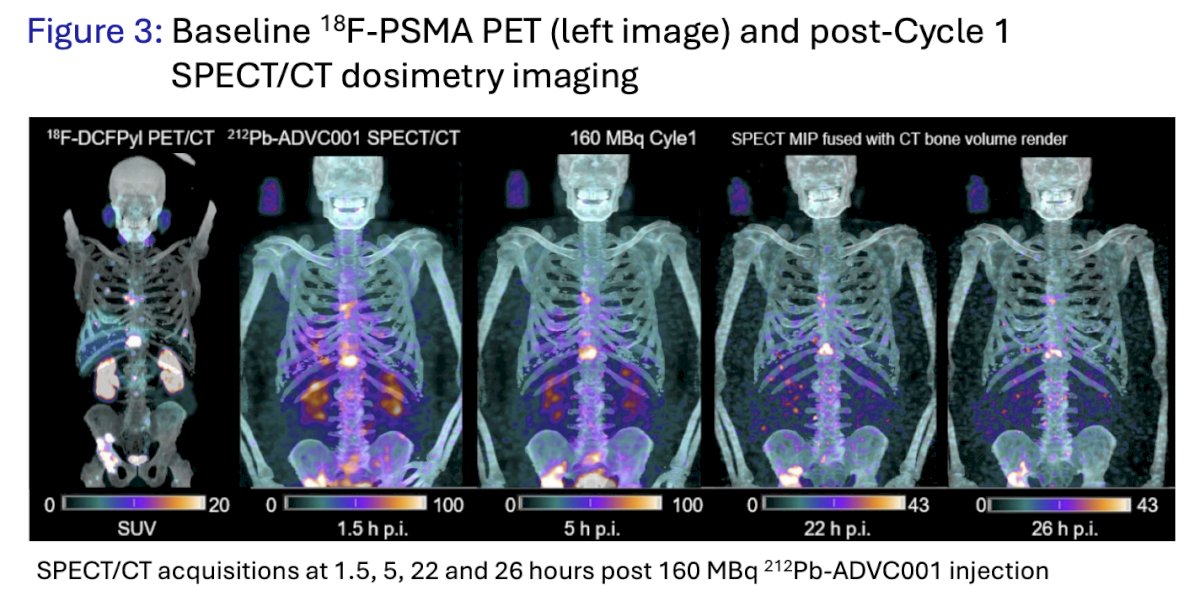 A 4-timepoint SPECT/CT imaging was acquired post-Cycle 1 between 1.5 and 28 hours (2.5 half-lives of 212Pb), with imaging and dosimetry analyses showing a favorable biodistribution of 212Pb-ADVC001: rapid and high uptake in tumor lesions concordant with PSMA PET, tumor retention over the decay of the isotope, fast renal clearance, and low uptake in normal organs including the salivary glands: