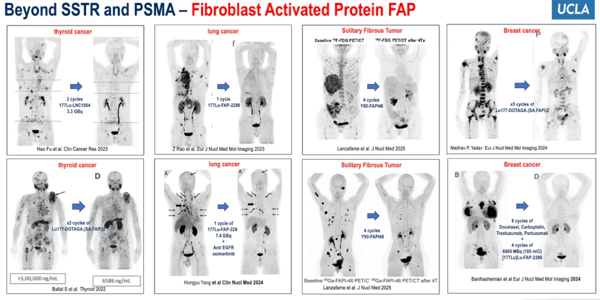 Dr. Calais then discussed the emerging role of Fibroblast Activated Protein (FAP) as a theranostic target, presenting compelling clinical imaging and treatment data across various malignancies, including thyroid, lung, solitary fibrous tumors, and breast cancer, where FAP-targeted radioligand therapy has shown promising responses after multiple treatment cycles.