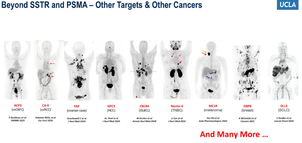 Dr. Calais emphasized that there are now numerous theranostic targets being investigated beyond SSTR and PSMA, including ACP3 in prostate cancer, CAIX in renal cell carcinoma, FAP in ovarian and other solid tumors, GPC3 in hepatocellular carcinoma, CXCR4 in lymphoma, Nectin-4 in triple-negative breast cancer, MC1R in melanoma, GRPR in breast cancer, and DLL3 in small-cell lung cancer illustrating how the field is rapidly evolving to encompass a wide range of malignancies.
