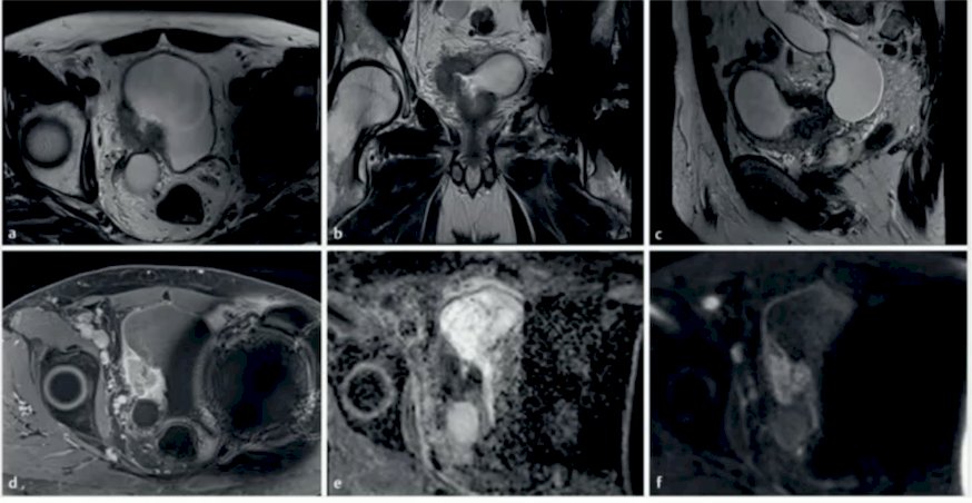 The strengths of mpMRI in the future of bladder cancer care are its diagnostic accuracy (~90% sensitivity, ~85% specificity), precise anatomic + functional staging, standardized reporting (VI-RADS), and improvement of multidisciplinary communication: