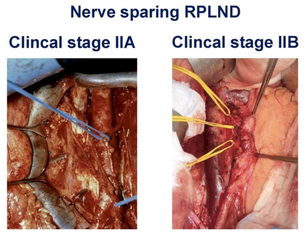 There were 34 patients with CS IIA/B pure seminoma prospectively recruited. Exclusion criteria were adjuvant chemotherapy following orchiectomy, CS IIC, previous retroperitoneal surgery or radiation, positive tumor markers. All patients underwent nerve sparing RPLND with a unilateral template and no adjuvant chemotherapy was delivered: