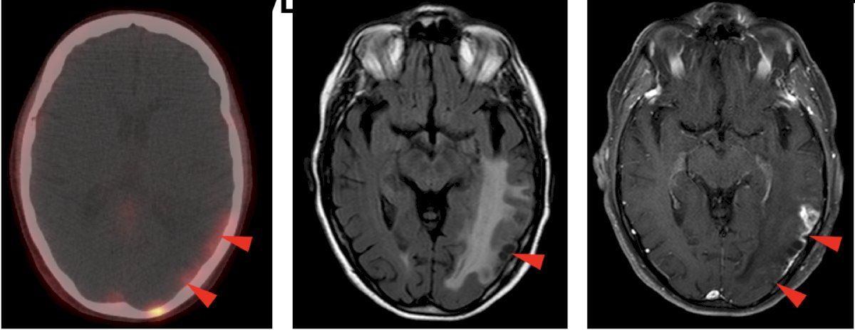 Uptake in post-radiation changes (cortical laminar necrosis):