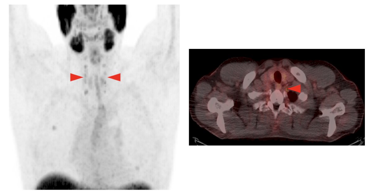 Uptake in ganglion structures (dorsal root and stellate ganglia):&nbsp;