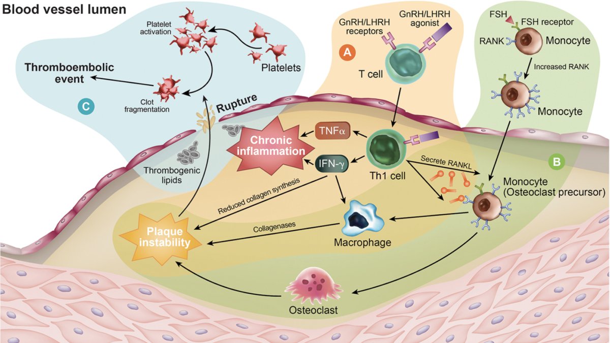 There are several clinical implications of these findings from REVELUTION, the first clinical trial to identify a biological basis of cardiovascular risk differences observed in the HERO trial. Leuprolide results in significant near-term coronary artery plaque progression, particularly non-calcified plaque volume, which is highly associated with major adverse cardiovascular events. This risk was not seen with relugolix. Additionally, there are peripheral GnRH/FSH-mediated pathways in the coronary endothelium, and immune effector responses can lead to plaque instability:2