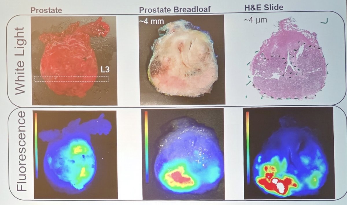 Additionally, a lymph node showed a strong IS-002 fluorescent signal prior to dissection, which was confirmed as a tumor-positive via frozen sectioning. Overall in this trial, residual disease, local (n = 8) and/or regional disease (n=2) was identified in 33% and 9% of patients, respectively. Fluorescence imaging was integrated directly into pathology processing steps, and IS-002 fluorescence correlated with regions of prostate cancer :