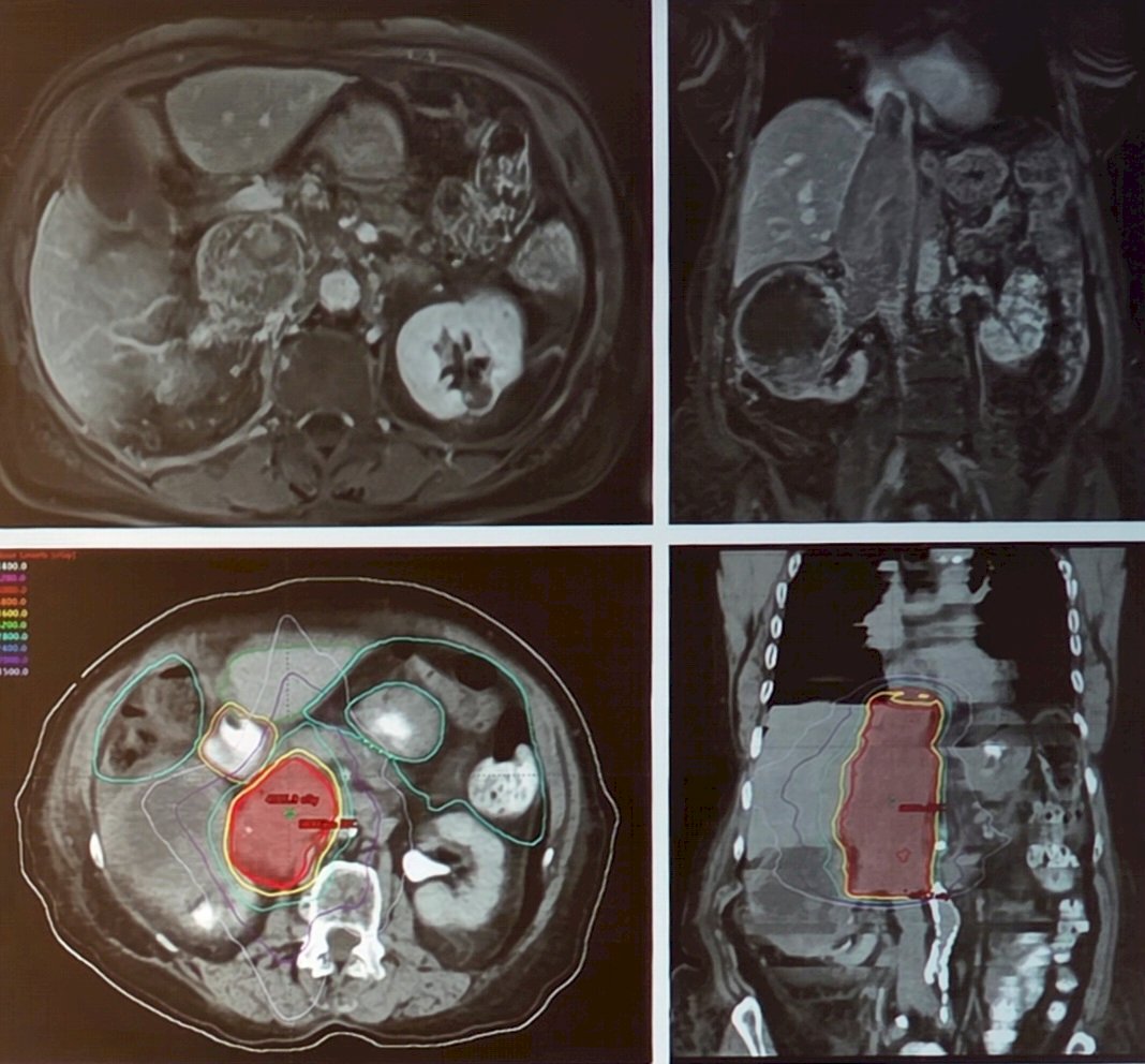 There were 23 patients enrolled between July 2015 and January 2024, with all patients receiving neoadjuvant stereotactic body radiotherapy to the IVC tumor thrombus. There were 22 patients that underwent surgery, with 1 patient being excluded secondary to widespread metastasis to the liver. Overall, 21 patients had follow-up, with 1 patient being excluded secondary to a perioperative death from COVID-19 pneumonia during the pandemic. The following figure highlights 36 Gy of radiotherapy in 3 fractions to the IVC tumor thrombus: