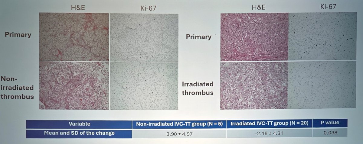 There were no radiation-related grade 4+ adverse events, and 36.4% of patients had a perioperative grade 3+ adverse event. From a correlative perspective, Dr. Lin and colleagues found that neoadjuvant stereotactic ablative body radiotherapy to the IVC tumor thrombus reduced Ki-67 expression in the tumor sample: