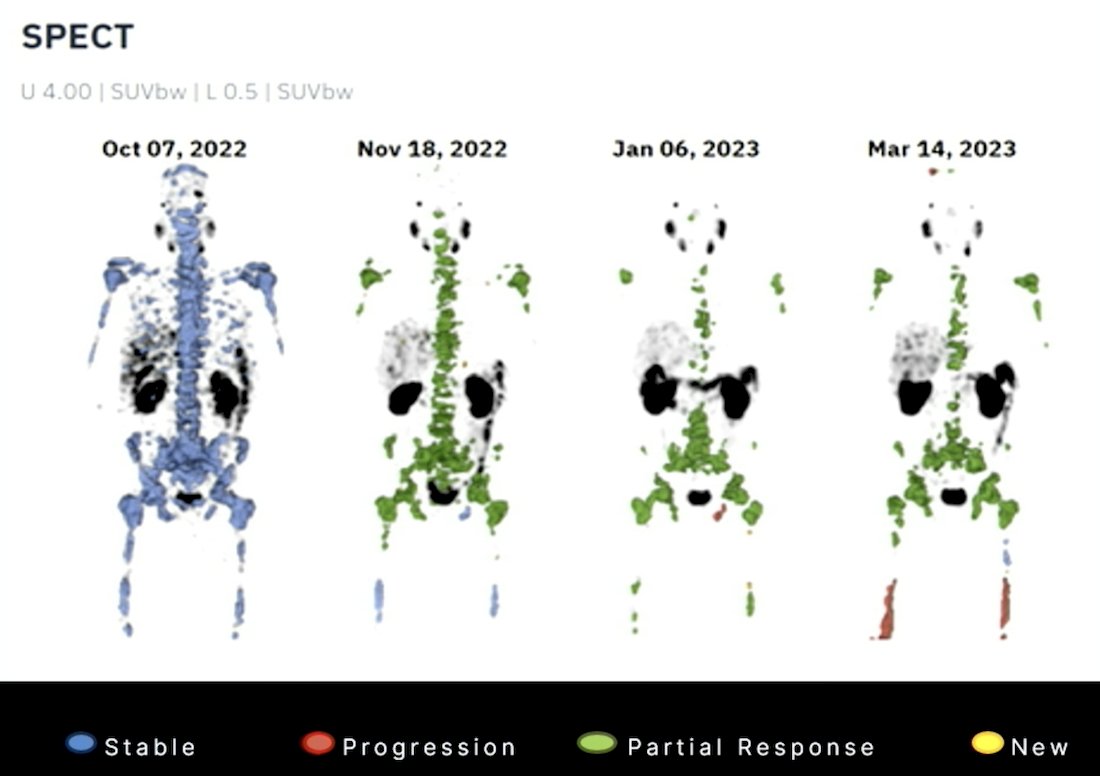  Subject-level metrics included PSMA total tumor volume and total lesion activity (Σ SUVmean&nbsp;× volume). Lesion outcomes at&nbsp;t + 1&nbsp;by volume were assigned by majority overlap with the subsequent study (1 = progression with volume increasing by >30%, 2 = stable, 3 = partial response with volume decreasing by >30%):