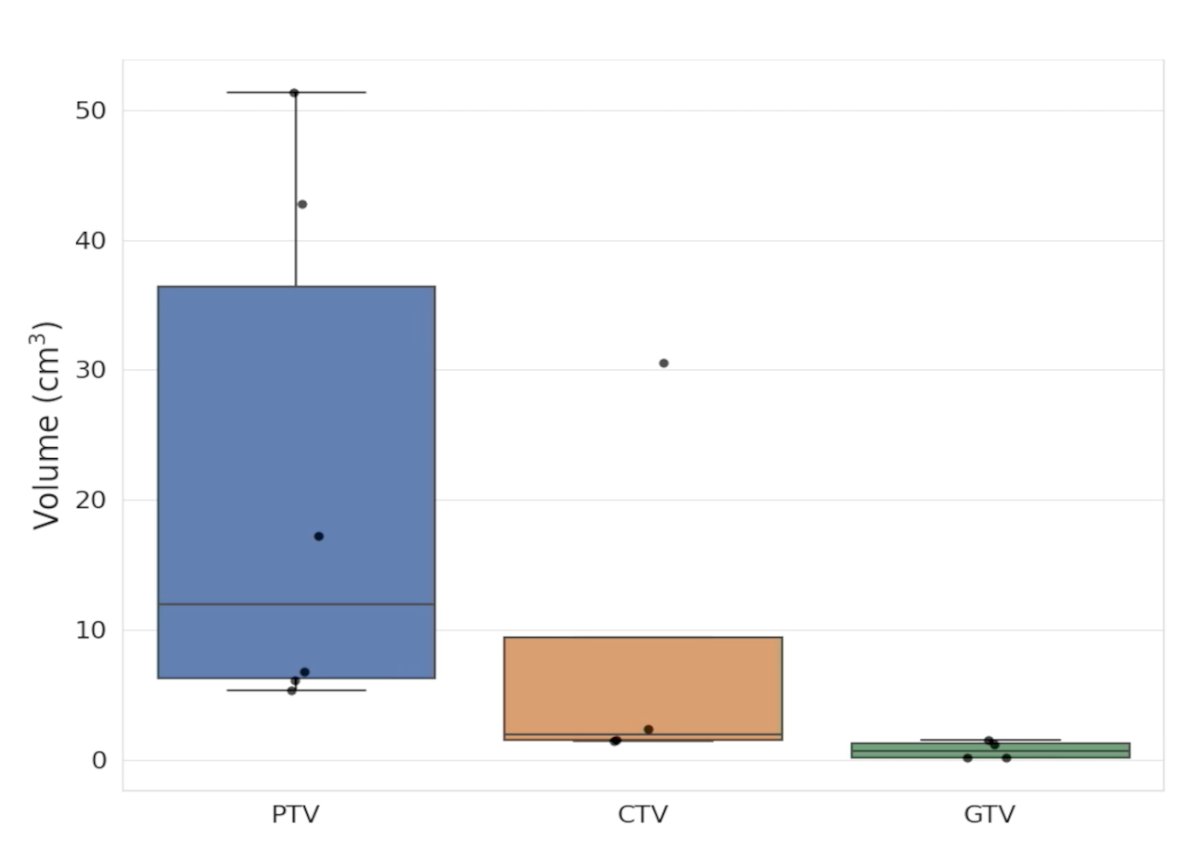 Among the 6 lesions analyzed, the 6 PTVs ranged from 5.4 – 51.3 mL (mean 21.6 mL), 4 CTVs ranged from 1.4-30.5 mL (mean 9.0 mL), and 4 GTVs ranged from 0.2-1.6 mL (mean 0.8 mL):
