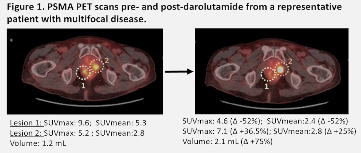 Baseline PSMA PET/CT showed nodal involvement in 4 patients and multifocal prostate uptake in 4 patients. No adverse events were reported, and all patients completed treatment. In the intention-to-treat population, 5 patients (31%) had any SUVmax increase after darolutamide, with 3 patients (18.8%; 90% CI 5.3–41.7) meeting the primary endpoint, with SUVmax increases of 36.5–62%:&nbsp;