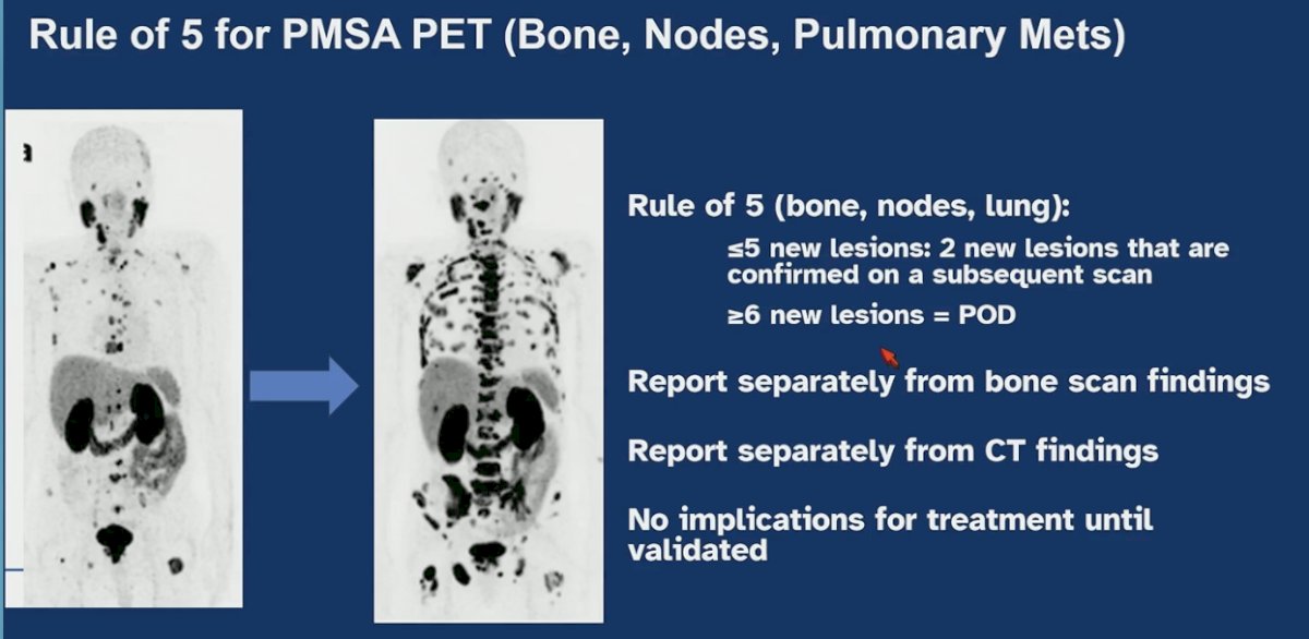 Dr. Armstrong clarified that the Rule of 5 also applies to PSMA PET for bone, nodal, and pulmonary metastases. If five or fewer new lesions are identified, confirmation on a subsequent scan is required; if six or more new lesions are present, this constitutes progression. These findings should be reported separately from conventional bone scan and CT results, and their treatment implications remain investigational until further validated. Importantly, the Rule of 5 does not apply to liver or other non-pulmonary visceral metastases, where any single new lesion in the liver, adrenal gland, or other non-pulmonary visceral site is considered progression.