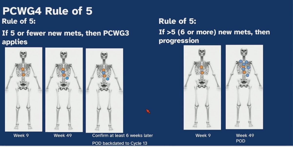 In PCWG4, the “Rule of 5” was introduced to refine the interpretation of new bone lesions on imaging. If five or fewer new metastases are detected, the prior PCWG3 confirmation approach applies, requiring a follow-up scan to confirm progression. However, if more than five new lesions are identified, this is considered sufficient evidence of progression without the need for confirmatory imaging (see below). This modification aims to balance the need to avoid misclassifying flare as progression while reducing delays in recognizing clear disease progression.