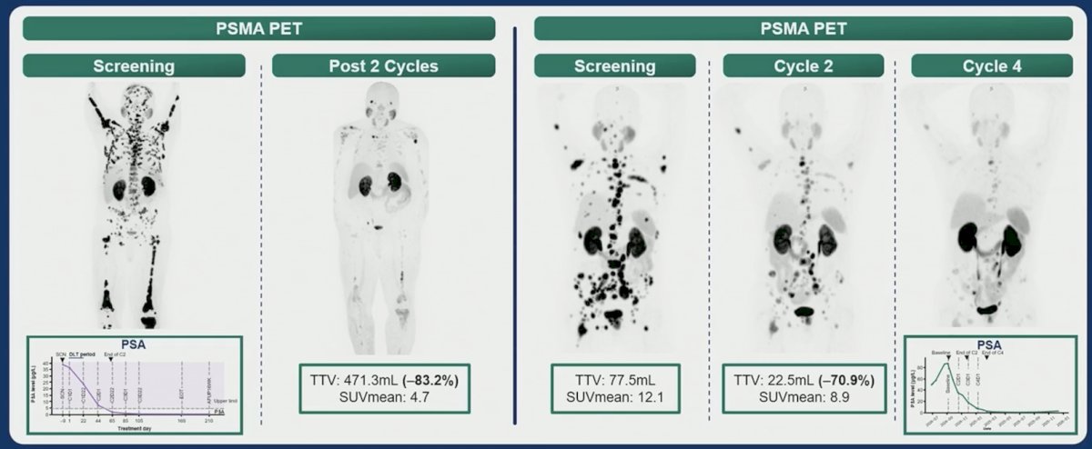The following highlights two patient cases demonstrating impressive responses, even after only two cycles of 225Ac-PSMA-Trillium:&nbsp;