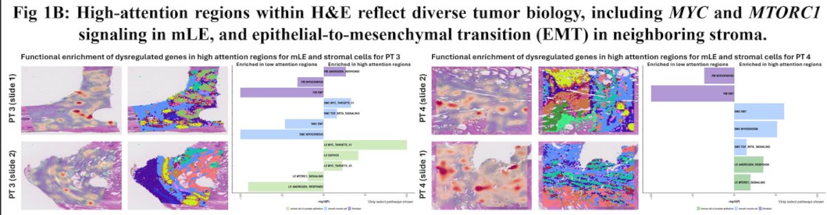 Moreover, the Artera digital pathology–derived MMAI captures multiple biologic pathways across prostate cancer specimens, reflecting the underlying tumor ecosystem rather than a single molecular axis. High-attention regions identified by the model correspond to tumor-relevant programs, including MYC-driven proliferation within malignant luminal epithelial cells and epithelial–mesenchymal transition in adjacent stromal compartments, among other coordinated pathway-level alterations.