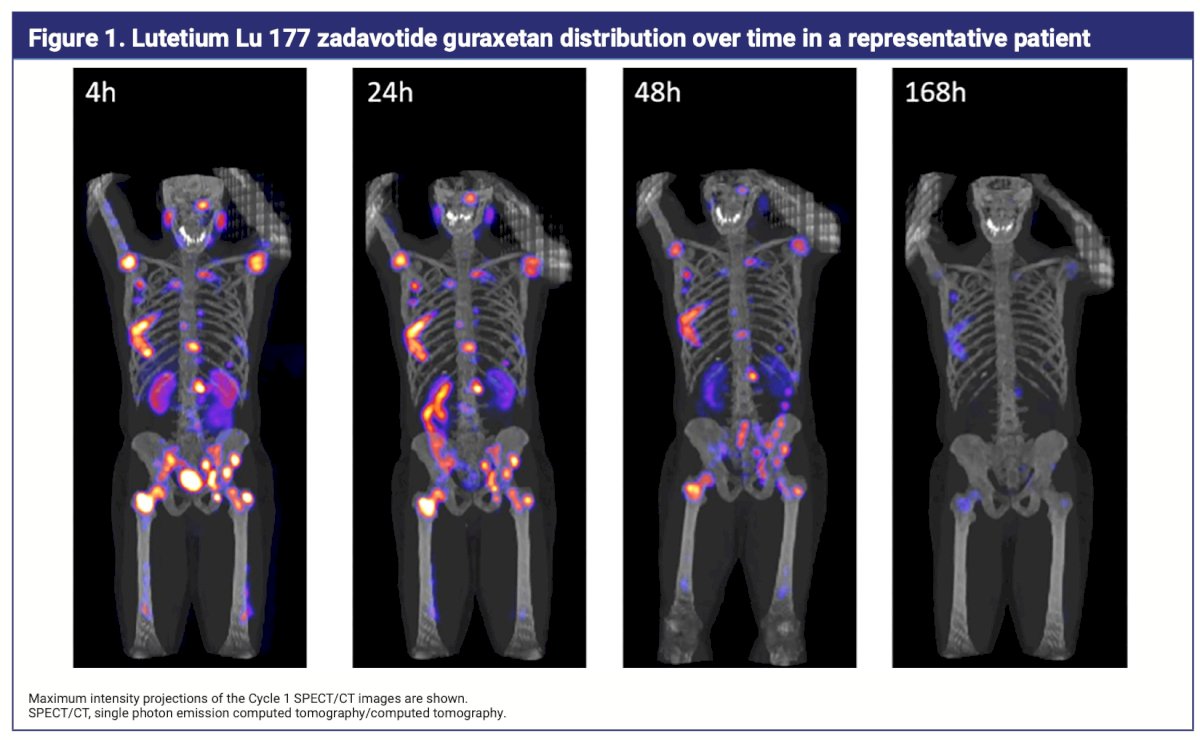 Overall, 27 patients were included in the substudy. Lutetium Lu 177 zadavotide guraxetan was predominantly observed in the kidneys, urinary bladder, gastrointestinal tract, lacrimal glands, and salivary glands at Cycle 1: