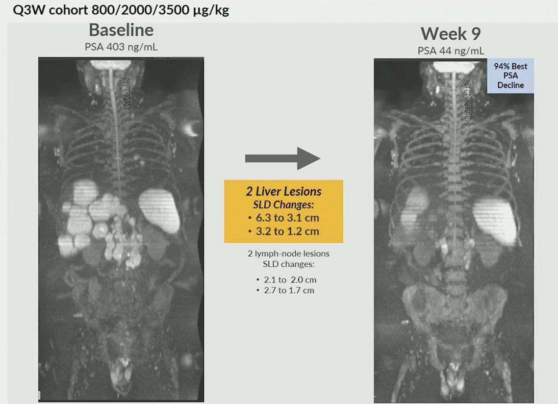 Dr. De Bono then provided two cases to highlight the clinical efficacy of VIR-5500. The first patient was a 75-year-old male with a high disease burden comprising liver and lymph node metastases. He had received 6 prior lines of therapy, including enzalutamide, docetaxel, cabazitaxel, and NX-1607. At week 9, he had a confirmed partial response, with a 94% PSA decline and metabolic response of PSMA-avid hepatic lesions. He continues on study and is on cycle 10 of therapy: