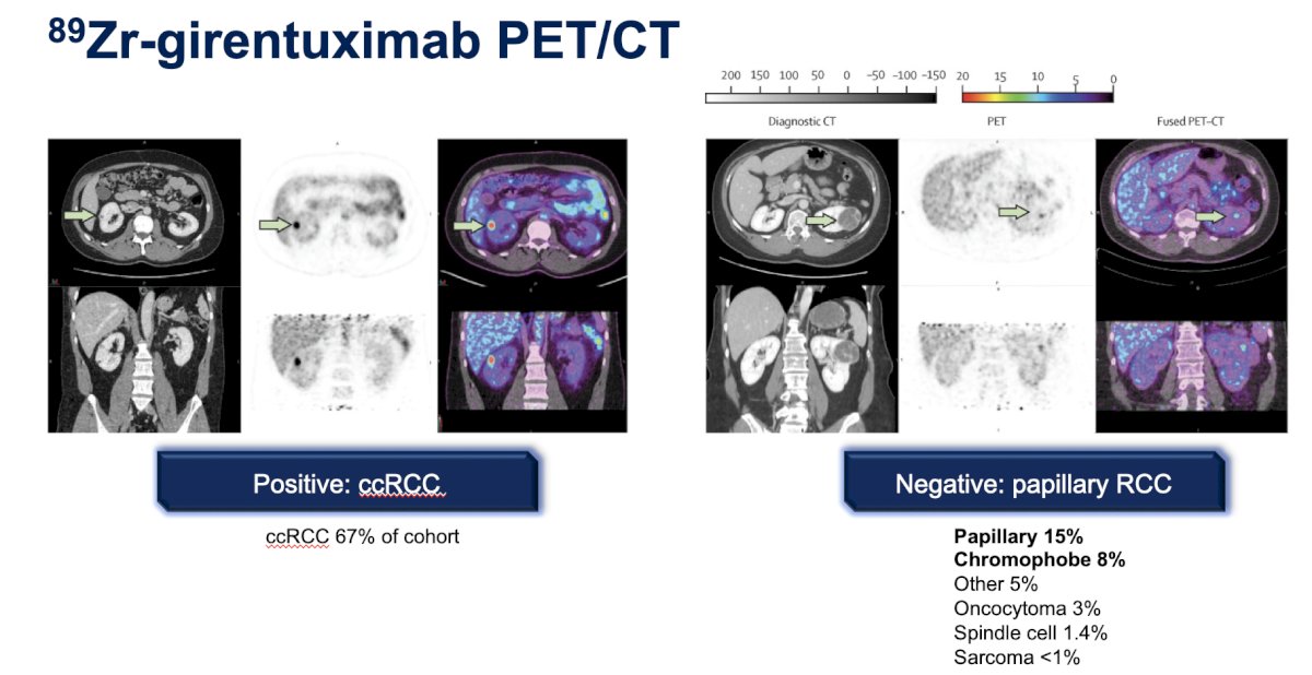 The ZIRCON trial1 was an open-label, multicenter clinical trial including patients with an indeterminate renal mass (≤ 7 cm; tumor stage cT1) who were scheduled for partial nephrectomy within 90 days from planned 89Zr-DFO-girentuximab administration. Enrolled patients received a single dose of 89Zr-DFO-girentuximab IV (37 MBq ± 10%; 10 mg girentuximab) on Day 0 and underwent PET/CT imaging on Day 5 (± 2 days) prior to surgery. Of 284 evaluable patients included in primary analysis, the average across all 3 readers for sensitivity and specificity was 86% [95% CI 80%, 90%] and 87% [95% CI 79%, 92%], respectively: