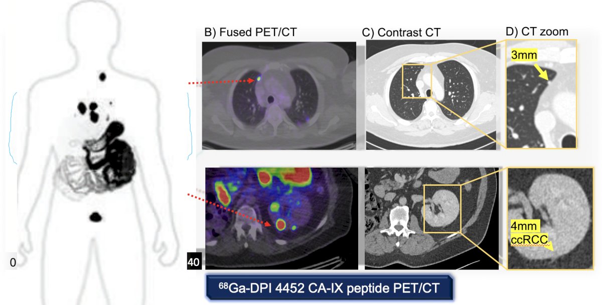 68Ga-DPI-4452, a first-in-class CA-IX-binding radiolabeled peptide, is the imaging agent of a theranostic pair with 177Lu-DPI-4452, developed for selecting and treating patients with CA IX-expressing tumors. In 2024, Dr. Hofman and colleagues published the first-in-human assessment of 68Ga-DPI-4452 in patients with RCC.2 Across 36 lesions, the SUVmax at 1 hour after administration ranged from 6.8 to 211.6 (mean 64.6 [SD, 54.8]). The kidneys, liver, and bone marrow demonstrated low activity, and 68Ga-DPI-4452 was rapidly eliminated from the blood and urine.&nbsp;Based on this very early experience, there was clear targeting of the CA-IX peptide with PET/CT:&nbsp;