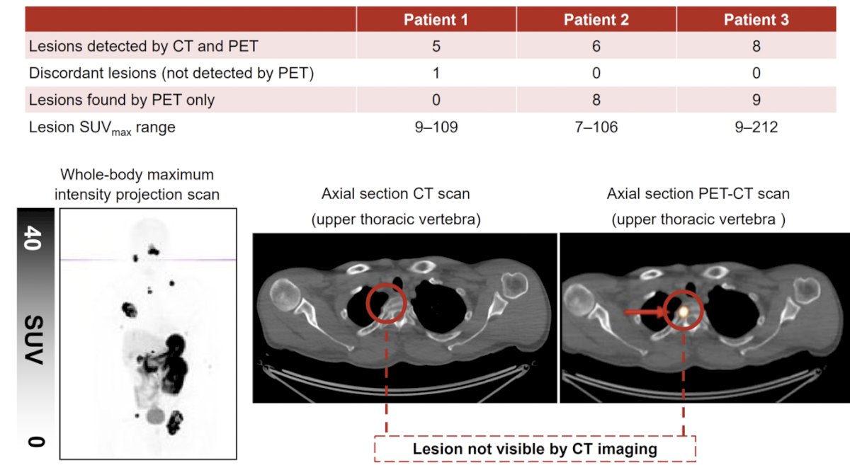 Among the first 3 patients assessed with 68Ga-DPI-4452, there were 17 metastases detected on 68Ga-DPI-4452 that were not detectable on CT: