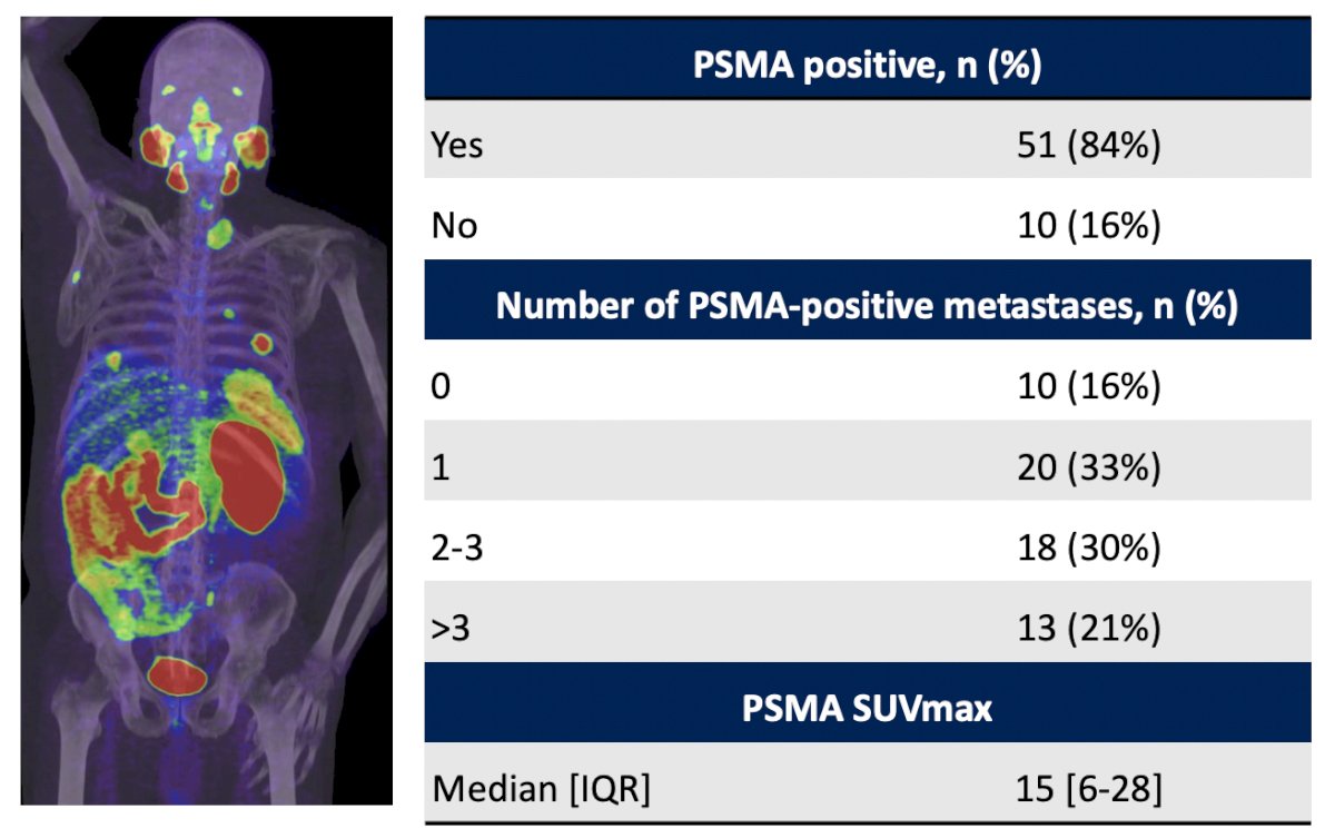 Dr. Hofman then discussed the role of PSMA PET/CT in the management of clear cell RCC. In 2022, Udovicich et al.3 retrospectively reviewed 61 patients who had a PSMA PET/CT of whom 54 (89%) had clear cell RCC. PSMA-positive disease was detected in 51 patients (84%). For 30 patients (49%) there was a change in management due to PSMA PET/CT (a high-impact change in 29 patients, 48%), and in 15 patients (25%), more metastases were detected on PSMA PET/CT than on CT. The sensitivity of combined PSMA PET/CT and diagnostic CT was 91% (95% confidence interval 77-98%):