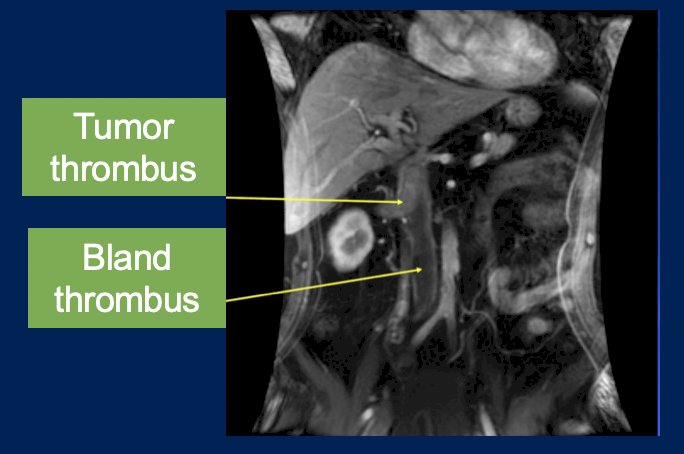 Dr. Gulati then discussed imaging tumor thrombi in RCC, noting that contrast-enhanced CT and MRI have equal efficacy for the detection of tumor thrombus. However, in some cases, an MRI may be warranted for surgical planning and to distinguish tumor thrombus from bland thrombus: