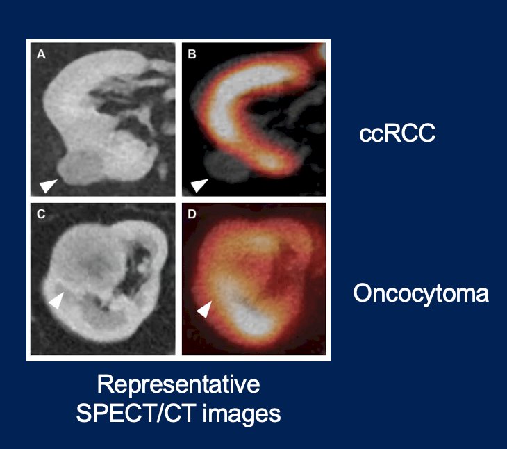 Dr. Gulati then discussed the role of 99mTc-sestamibi imaging in the diagnosis of benign and indolent renal masses, with the following representative SPECT/CT images: