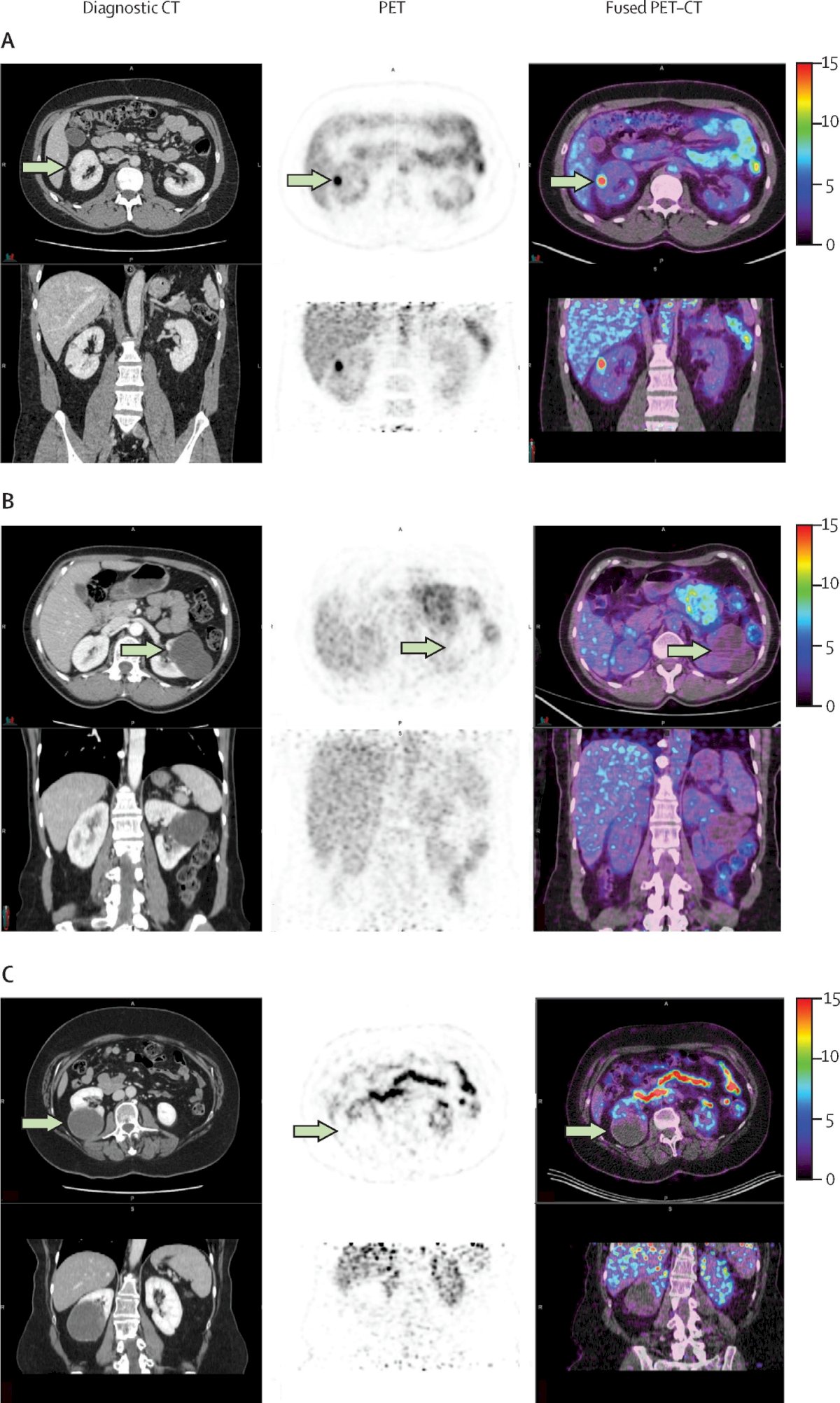 The ZIRCON trial2 was an open-label, multicenter clinical trial including patients with an indeterminate renal mass (≤ 7 cm; tumor stage cT1) who were scheduled for partial nephrectomy within 90 days from planned 89Zr-DFO-girentuximab administration. Enrolled patients received a single dose of 89Zr-DFO-girentuximab IV (37 MBq ± 10%; 10 mg girentuximab) on Day 0 and underwent PET/CT imaging on Day 5 (± 2 days) prior to surgery. Of 284 evaluable patients included in primary analysis, the average across all 3 readers for sensitivity and specificity was 86% [95% CI 80%, 90%] and 87% [95% CI 79%, 92%], respectively, for co-primary endpoints, and 85% [95% CI 77%, 91%] and 90% [95% CI 79%, 95%], respectively, for key secondary endpoints: