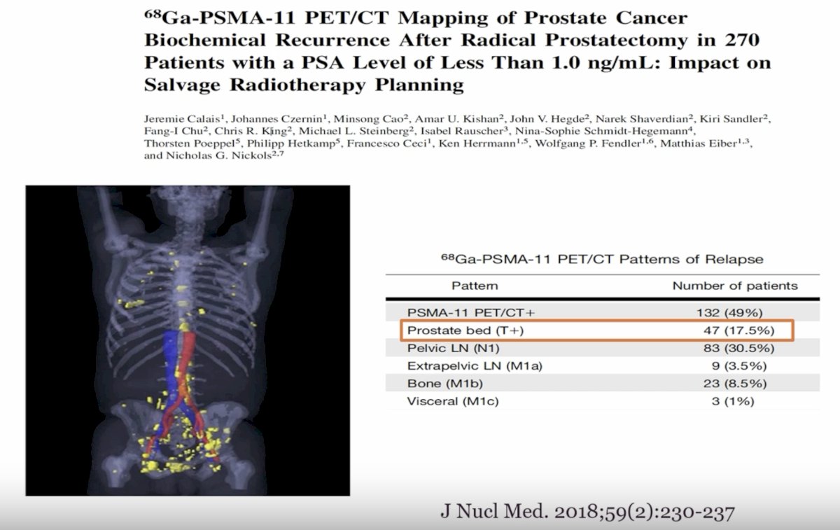 These data reinforce that relapse after radical prostatectomy is commonly not local only, even at relatively low PSA values, and that visible local recurrence should be interpreted in the broader context of potential occult regional or distant disease.