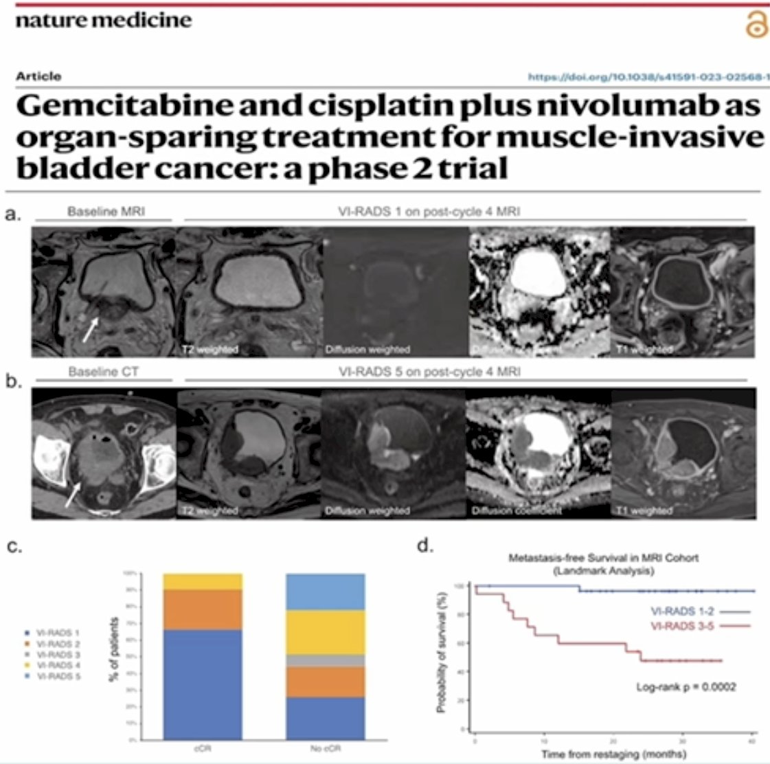 Imaging has also emerged as an important tool for identifying residual disease following neoadjuvant therapy. Multiparametric MRI using the Vesical Imaging Reporting and Data System (VI-RADS) can stratify patients according to the likelihood of residual tumor. In the analysis presented, patients with VI-RADS scores of 1–2 after chemotherapy demonstrated excellent metastasis-free survival, whereas patients with VI-RADS scores of 3–5 experienced significantly worse outcomes (p=0.002; figure below). These findings suggest that imaging may provide a non-invasive method for identifying patients with a high probability of complete response.