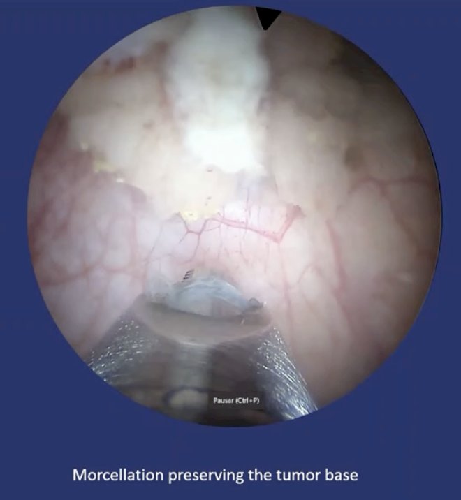 Holmium laser en bloc resection specimens were extracted based on their size: