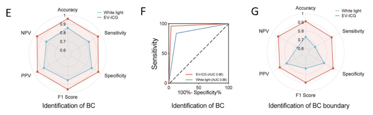 The first in human fluorescence-guided TURBT using indocyanine green to enfortumab vedotin markedly enhanced real-time tumor visualization, improved margin assessment, and facilitated the detection of residual tumors and CIS: