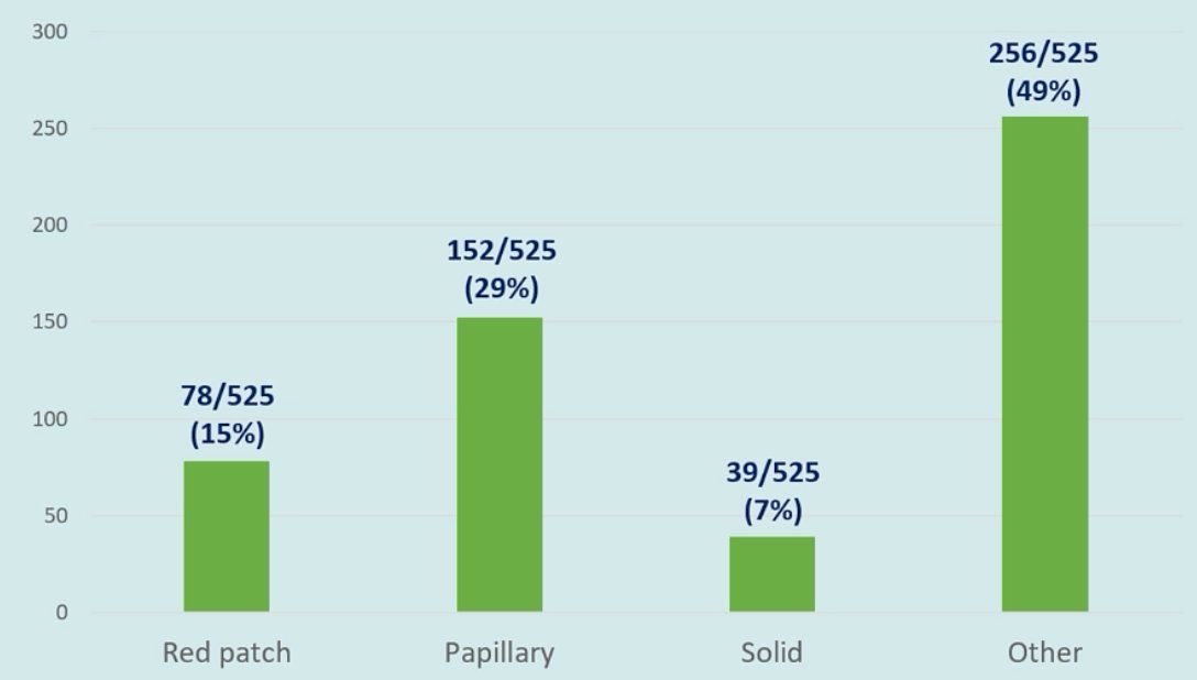 At flexible cystoscopy, abnormalities were identified in 525/1,733 (30%) of patients, including solid lesions suspicious for muscle-invasive bladder cancer in 39 patients (7%), of whom 34 proceeded to TURBT:
