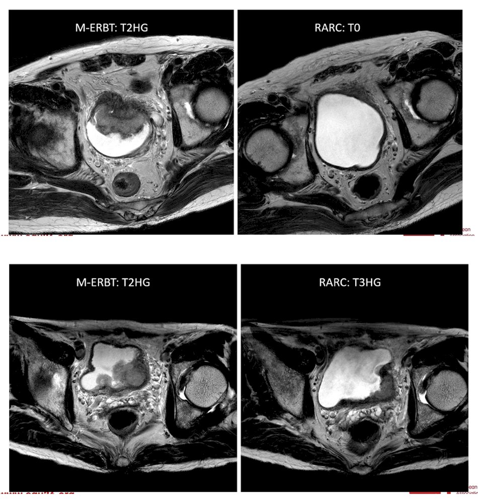 Dr. Teoh also presented illustrative clinical examples demonstrating how post-TURBT MRI may assist in staging and treatment planning. In one case, he performed an en bloc maximal TURBT, and subsequent MRI showed no evidence of residual disease; the patient later underwent robot-assisted radical cystectomy (RARC) and final pathology confirmed pT0 disease. In contrast, in another seemingly similar case, post-TURBT MRI demonstrated signs suggestive of extravesical extension, and surgical pathology ultimately confirmed pT3 disease. These examples highlight the potential role of MRI in improving post-resection staging and helping guide decisions between bladder-preserving strategies and definitive surgery.