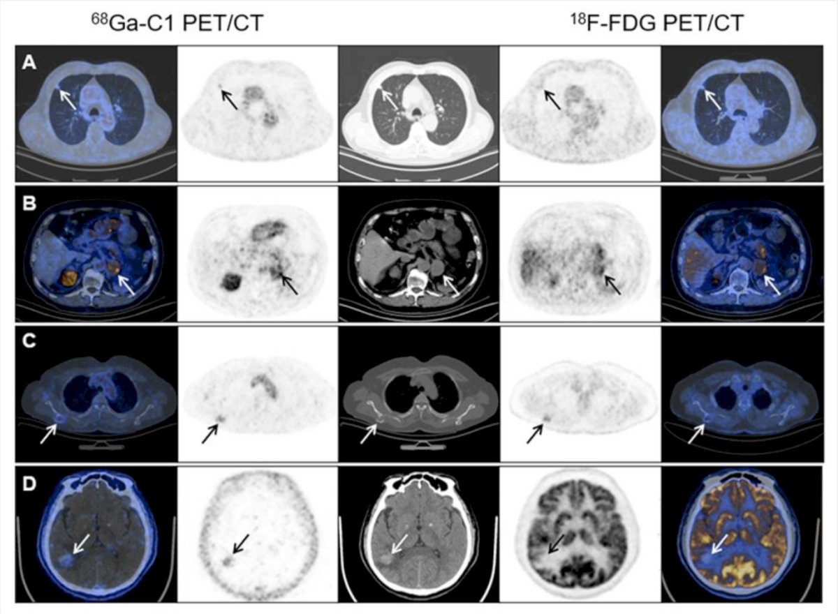 In the translational study, five patients with newly detected renal mass and seven clear cell RCC patients with suspected recurrence or metastasis after partial or complete nephrectomy were enrolled. Ten clear cell RCC patients and one patient with angiosarcoma showed positive CAIX expression and high uptake of 68Ga-C1, while one patient confirmed pathologically as non-clear cell RCC showed negative uptake of 68Ga-C1.&nbsp;The following figure compares metastatic lesion detection using 68Ga-C1 and 18F-FDG PET/CT:&nbsp;