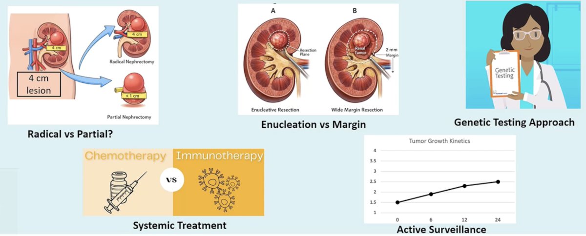 Dr. Shuch states that it is important to understand and recognize rare renal tumors because although most neoplasms are cancers of “standard histology”, (i) 30% of partial nephrectomies have historically been for benign lesions (not just oncocytoma), (ii) ~15-25% of rare kidney tumors are indolent and have limited metastatic potential, (iii) 5-10% of rare kidney cancers are highly aggressive and infiltrative, and (iv) 2-8% of RCC have a strong genetic component, with ~15% of rare tumors being hereditary. For the practicing urologists, the question of importance is whether a tumor should be a radical versus a partial nephrectomy, an enucleation versus a more adequate margin surgical approach should be taken, what genetic testing approach should be used, is there a role for systemic therapy, and should this patient be managed with active surveillance: