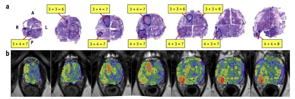 Finally, Dr. Punnen noted several future directions. The first is the use of artificial intelligence for prostate MRI:&nbsp;