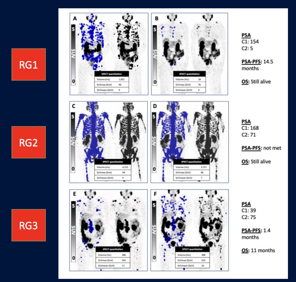 In 2023, Dr. Emmett and colleagues reported results of their study evaluating progression-free survival and overall survival based on treatment interval adjustment utilizing 177LuPSMA 24-hour SPECT/CT and early PSA response.4 There were 125 men treated with 6 times weekly 177LuPSMA-I&T doses (median 3 cycles, IQR 2-4) at a median dose of 8.0 GBq (95% CI 7.5-8.0). Following dose 2 (week 6), a composite PSA and&nbsp;177LuPSMA 24-hour SPECT/CT imaging response determined ongoing management: