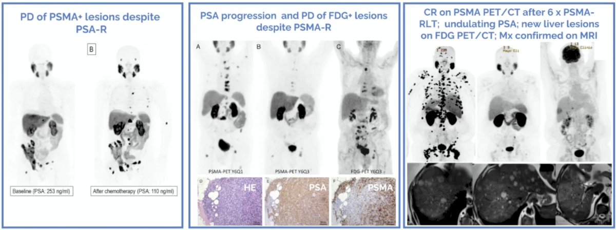 Dr. von Amsberg emphasized that up to 30% of mCRPC patients experience PSA negative progression, and up to ~15-20% of mCRPC patients develop PSMA-low or PSMA-negative disease:&nbsp;